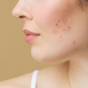 Cheek with visible acne spots