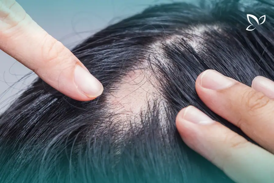 Fingers parting hair to show a smooth bald patch on the scalp