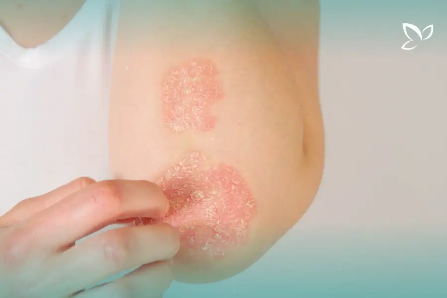 Scaly red patches on an elbow